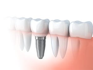 Dental Implants in Salt Lake City - Smiles