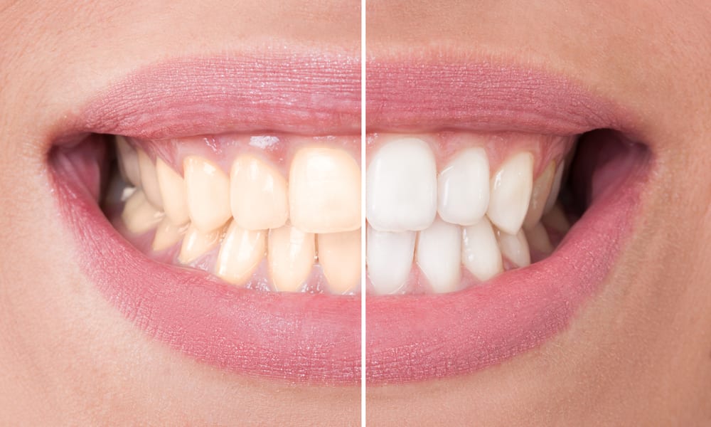 Teeth Whitening in Salt Lake City
