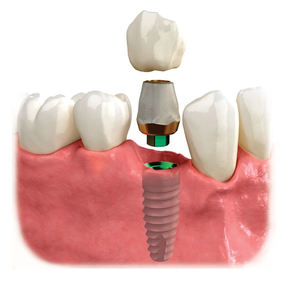 Aftercare for Dental Implants in Holladay, Utah