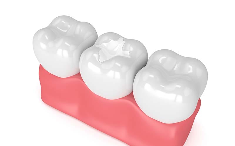 Composite Tooth Colored Fillings